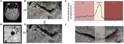 In-vivo MRI Reveals Changes to Intracerebral Vasculature Caliber in HIV Infection
